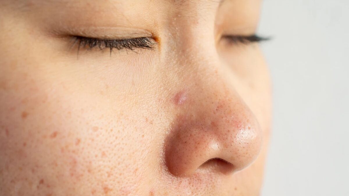 Dermatologista explica por que é tão difícil eliminar cravos do nariz