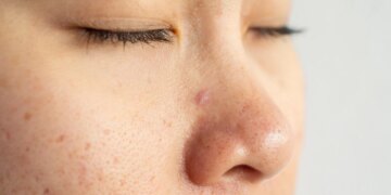 Dermatologista explica por que é tão difícil eliminar cravos do nariz