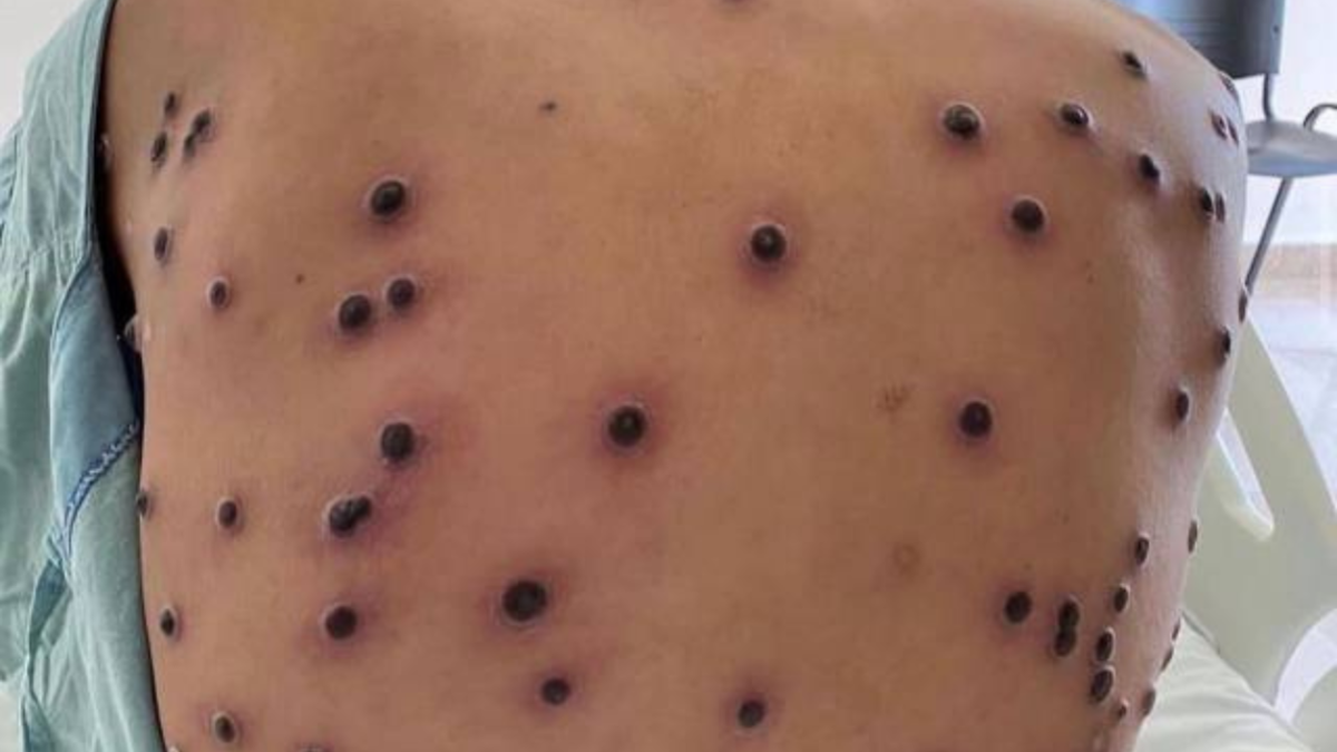 Mpox no Brasil: Infectologista explica o que é a doença, sintomas e como acontece a transmissão