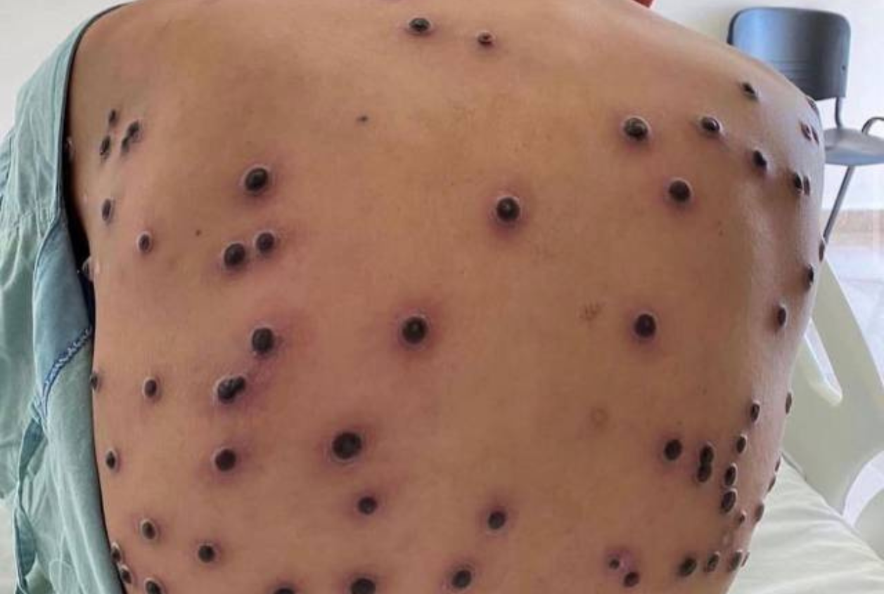 Mpox no Brasil: Infectologista explica o que é a doença, sintomas e como acontece a transmissão