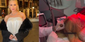 Queda de cabelo em Virginia Fonseca: sabe o que causa a alopecia