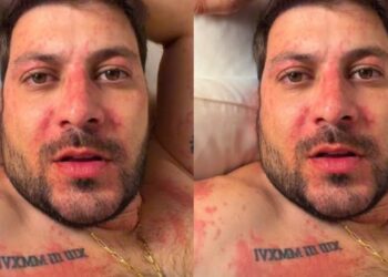 Ex-BBB Caio Afiune é internado após crise alérgica