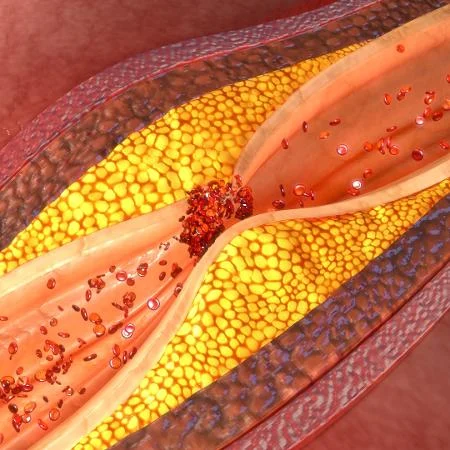 Alimentos que ajudam a evitar o entupimento de veias e artérias