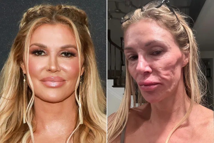 Brandi Glanville pede mais exames e critica médicos por desfiguração facial inexplicável