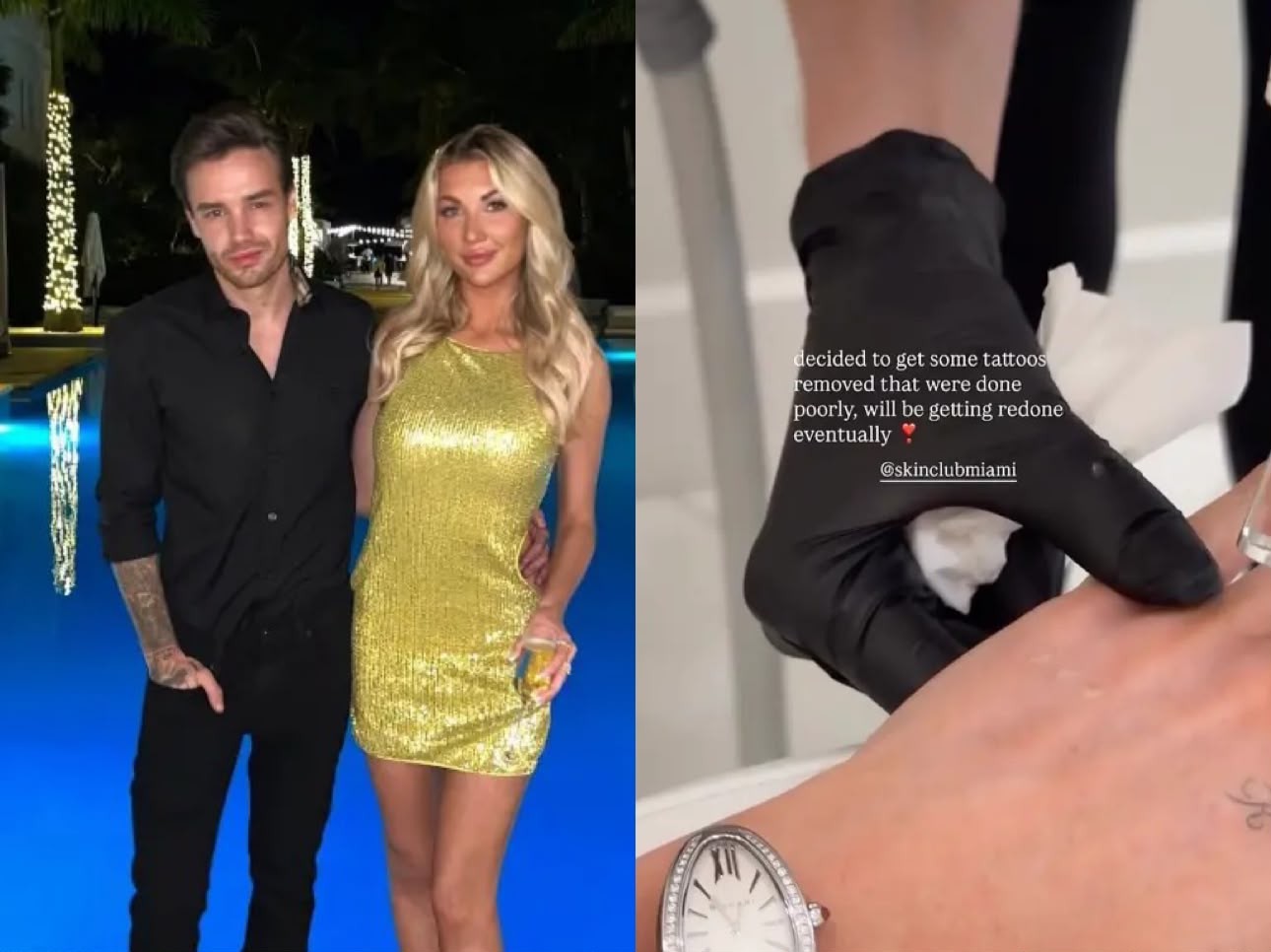 Kate Cassidy inicia remoção de tatuagem em homenagem a Liam Payne e explica decisão