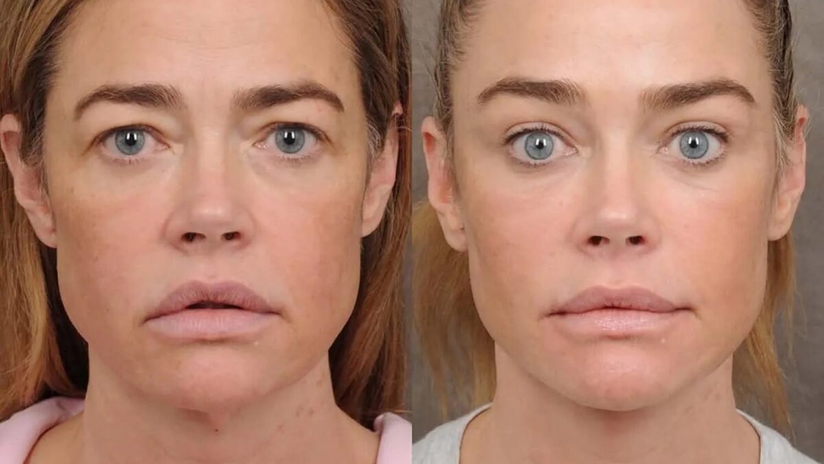 Denise Richards revela procedimentos estéticos que transformaram seu rosto aos 55 anos