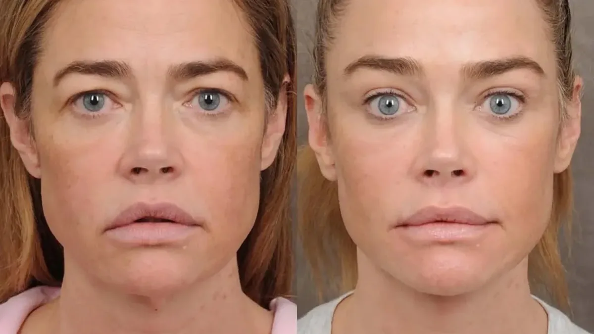 Denise Richards revela procedimentos estéticos que transformaram seu rosto aos 55 anos