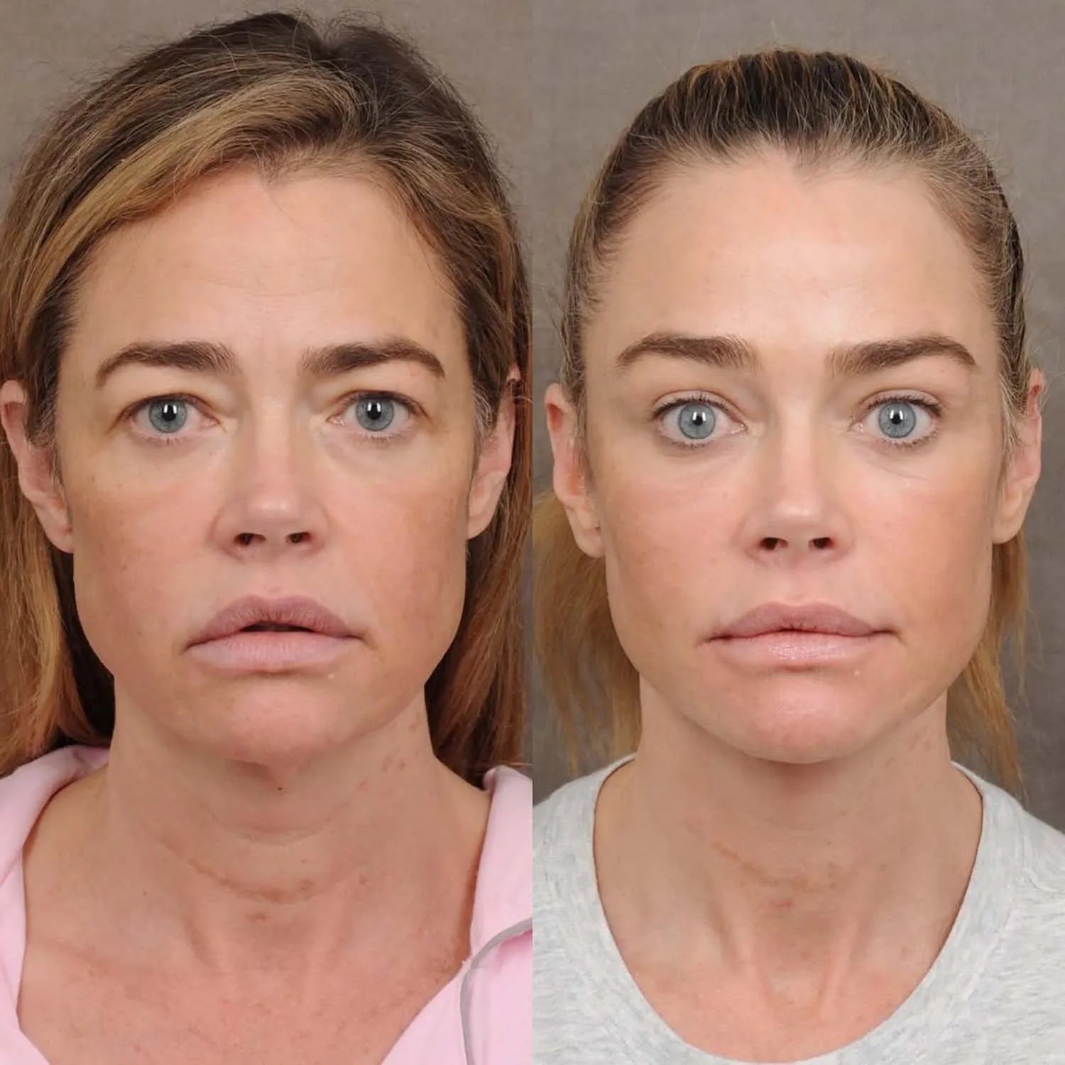 Denise Richards revela procedimentos estéticos que transformaram seu rosto aos 55 anos
