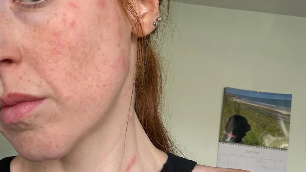 Influenciadora relata ataque de percevejos em hotel e sofre com picadas em Cambridge