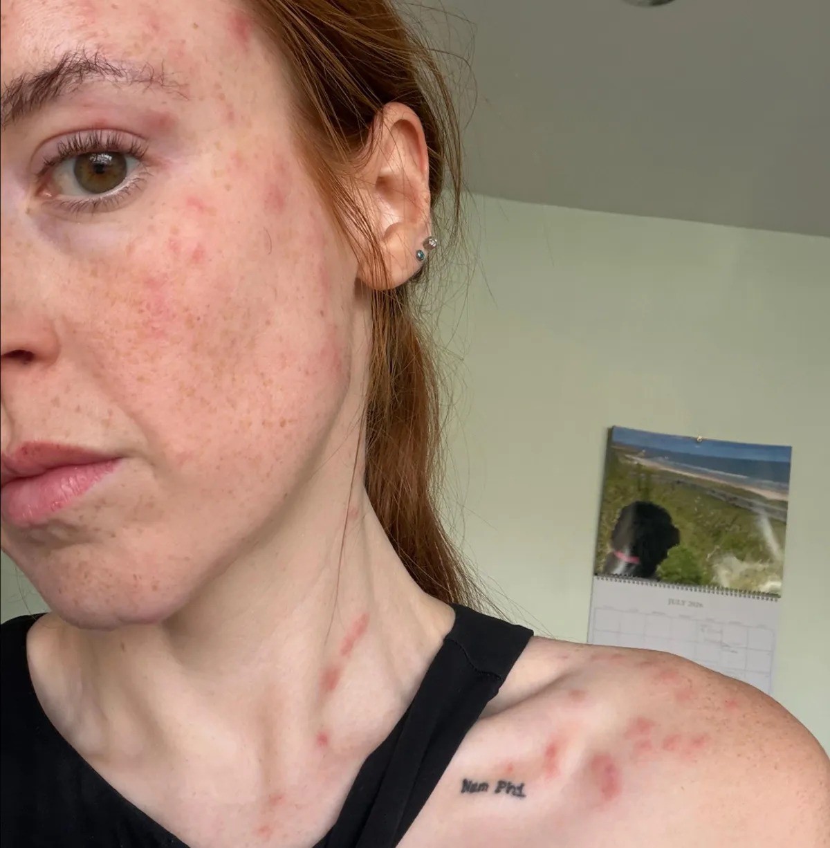 Influenciadora relata ataque de percevejos em hotel e sofre com picadas em Cambridge