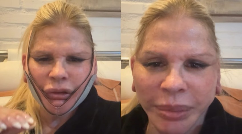 Monique Evans revela rosto após minilifting e se diz impressionada com resultado