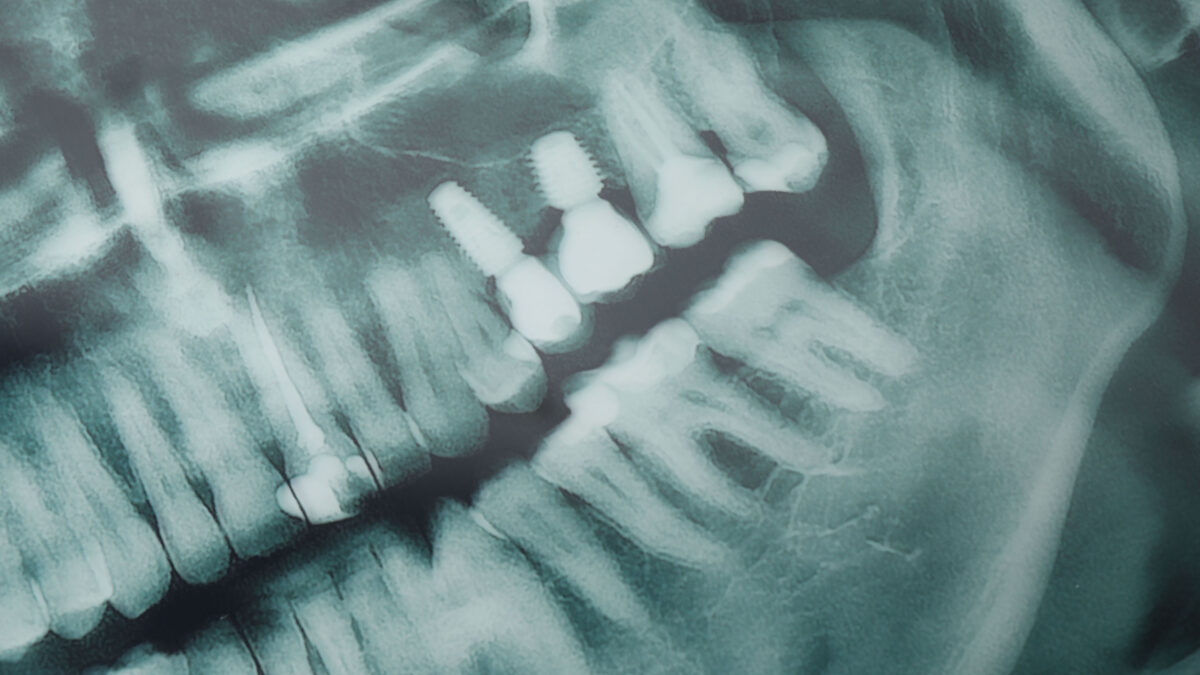 USP desenvolve IA que auxilia dentistas na detecção de cáries em radiografias