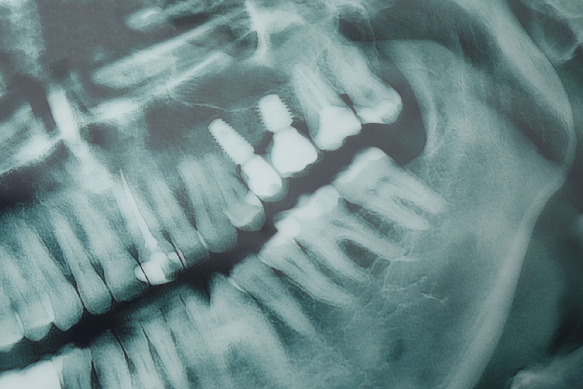 USP desenvolve IA que auxilia dentistas na detecção de cáries em radiografias