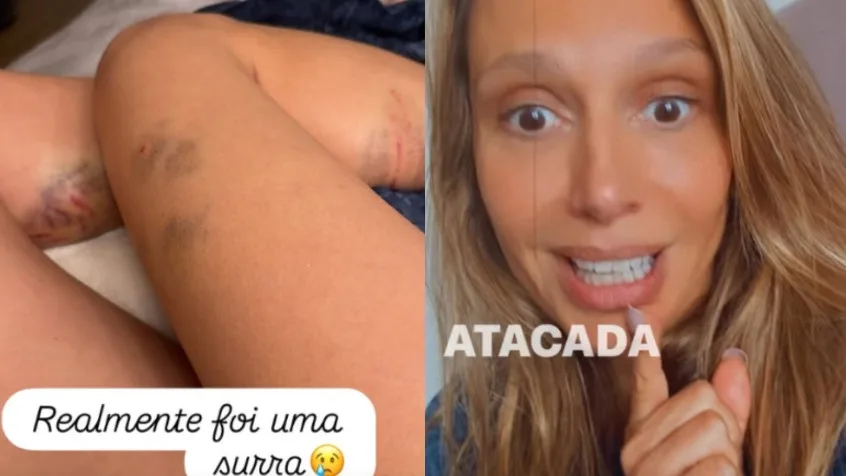 Luisa Mell revela ataque de cachorros e exibe hematomas: 'A culpa foi minha'